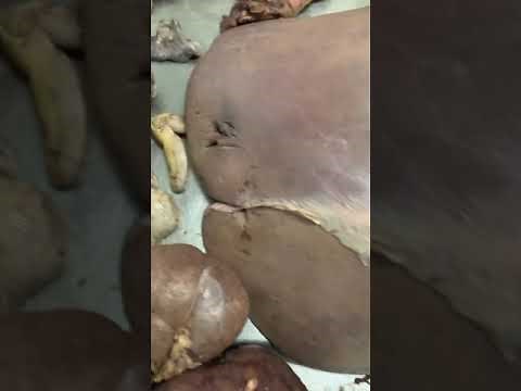 The Autopsy of a 29 year old female