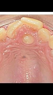 Mesiodens supernumerary tooth extraction