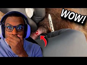 THAT PROJECTILE SCALP CYST WAS INSANE!