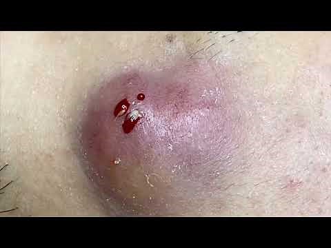 Inflammatory Acne Cyst