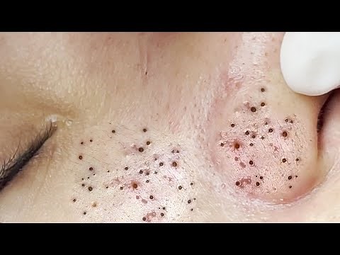 Suri Job #671: Awesome Blackheads and Acne Extraction