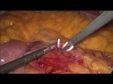 Laparoscopic Sigmoid Resection Due to Cancer • Video • MEDtube.net