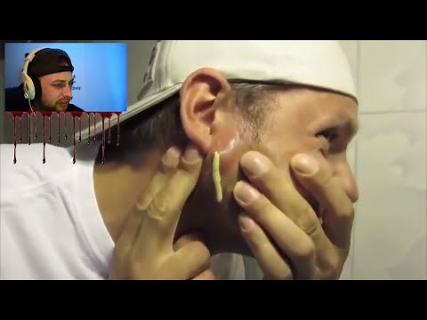 huge flying cyst popping explosions, they need dr pimple popper