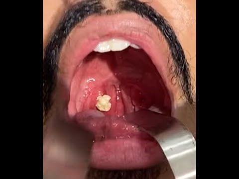 Removing Tonsillolith/ Stones in Tonsils- Dr. V. Narendrakumar