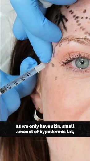 Here’s how many units of Botox I injected in this patients forehead #botox #aesthetics