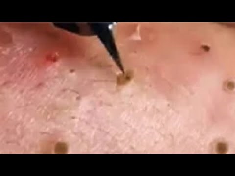 Full Giant Blackheads Popping Video, Blackheads Removal 2019