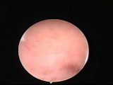 Cervix Obstructed By Intrauterine Adhesions - Hysteroscopic Treatment • Video • MEDtube.net