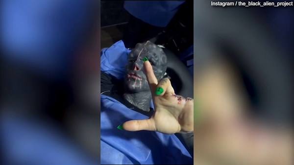 2021: Man has two fingers cut off so hand looks like an alien claw