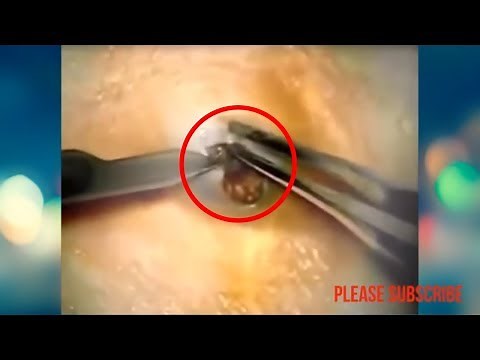 Top 5 Biggest Blackhead on the world #14