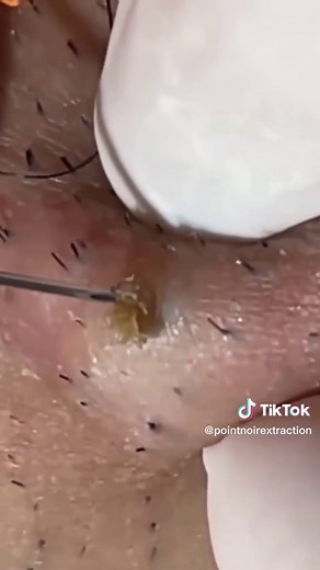 Retirer un gros point noir #blackhead #satisfying #blackheadremoval #acne #fyp #foryou