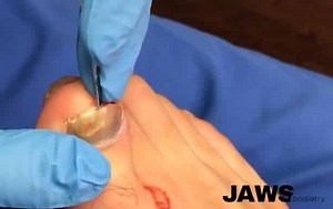 Removing a Dead Toenail - Toenail Removal Surgery Video