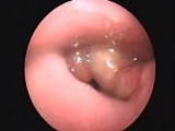 Epiglottitis In Scopy (OPD) • Video • MEDtube.net