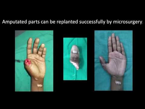 Preservation of amputated part for reattachment surgery