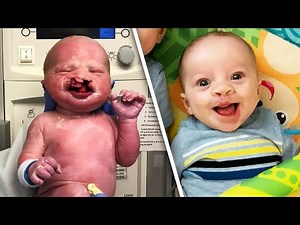 6-Month-Old Baby Smiles for the First Time After Double Cleft Lip Surgery