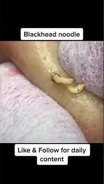 Extreme pimple popping , Blackhead removal , Blackheads extraction 2023