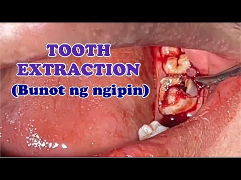 TOOTH EXTRACTION: Pulp Polyp 🦷