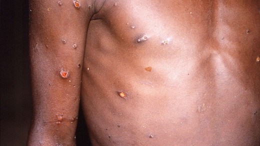 The symptoms, treatment for monkeypox