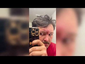 Satisfying Pimple Popping & Cyst Extractions - 189