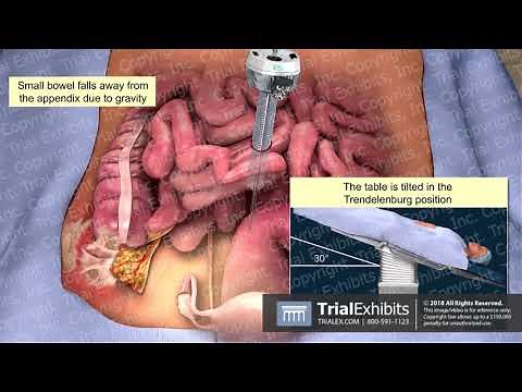 Laparoscopic Appendectomy