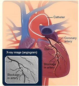 Here is a great demonstration showing how contrast dye allows blockages to be seen during a heart cath. #heartdisease #heartdiseaseawareness #coronaryheartdisease #patients #Nurse #Nursing #Nursepractitioner #instanursing #aprn #heart #heartfailure #cardiology #cathlab #cathlabnurse #studentnurse #nursingstudent #heartmonth #hearthealthmonth #americanheartmonth #hearthealth #hearthealthy #heartawarenessmonth | CardioVisual