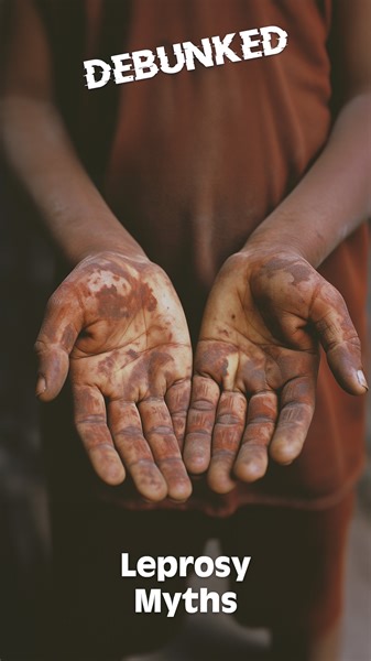 Leprosy is caused by infection with the bacterium Mycobacterium leprae. Symptoms include light colored or red skin patches with reduced sensation, numbness and weakness in hands and feet. The only way to become infected is through prolonged close contact with someone who has the untreated disease. #health #skinhealth #leprosy | Dherbs | Facebook