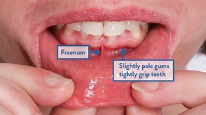 How to check your mouth !!!  A Guide to spotting mouth cancer  #OralCancer #MouthCancer | Dr Moin Khan | Facebook