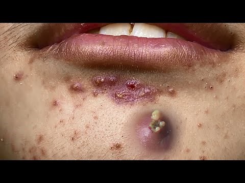 Big Cystic Acne Blackheads Extraction Blackheads & Milia, Whiteheads Removal Pimple Popping