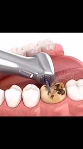 3.7K views · 14 reactions |  Dental Crown Procedure Dr Moin Khan #teeth #dentista #dentist #dental #dentalcare #crown #dentistry | Dr Moin Khan | Facebook