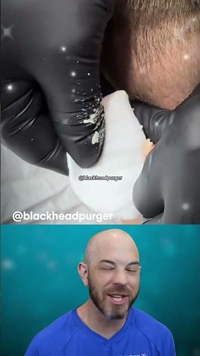 Watch out for this MASSIVE cyst pop on the neck! (@blackheadpurger on TT) #cyst #satisfying