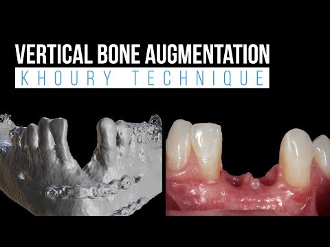 Vertical Bone Augmentation - Khoury Technique