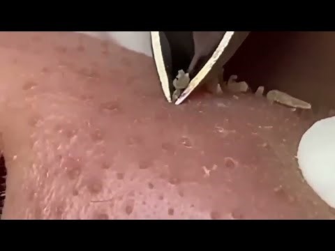 Precision Blackhead Extraction: Tweezer Technique