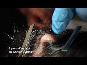 Explosive Pilar Cyst. Dr Khaled Sadek. LipomaCyst.com