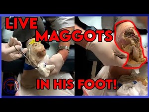 Larva Therapy For Diabetic Foot Wounds (Live Maggots In Foot!)
