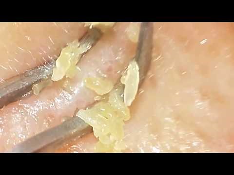 Huge yellow clogged pores removal with clip curved tweezers. Blackheads Removal.