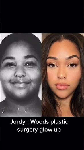 Jordyn Woods Before and after plastic surgery