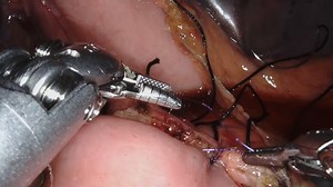 Video: Robotic Central Pancreatectomy with Roux-en-Y Pancreaticojejunostomy