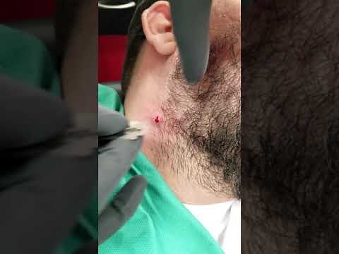Massive ingrown hair removal (warning graphic bloody content)