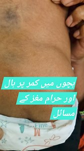 37K views · 208 reactions | Spinal bifida occulta - Neural tube defect #spinehealth #neurology #NTD | Dr. Arshad Mehmood - Child Specialist | Facebook