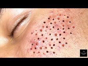 Satisfying Extractions | Relaxing! Blackheads X Whiteheads | NILUFER ESTHETICS SPA