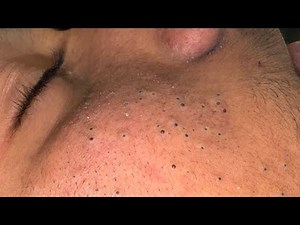 Deep Pore Cleansing | Acne Treatment & Blackhead Removal Routine
