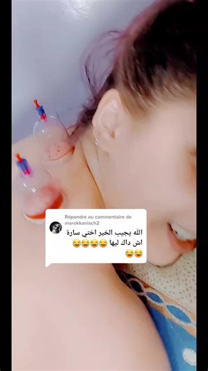 Suction Cup Therapy Demonstration on Skin