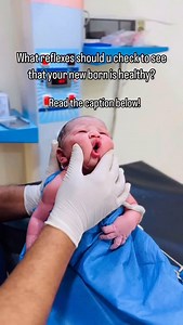 Newborn babies have several reflexes that doctors check for shortly after birth and during routine checkups. These reflexes, like the Moro (startle) and rooting reflex, are important indicators of neurological development. Here are some common reflexes checked in newborns: Rooting reflex: When the corner of a baby’s mouth is touched, they will turn their head and open their mouth in search of food. Sucking reflex: Babies suck instinctively when their mouth is stimulated. Moro reflex (startle ref