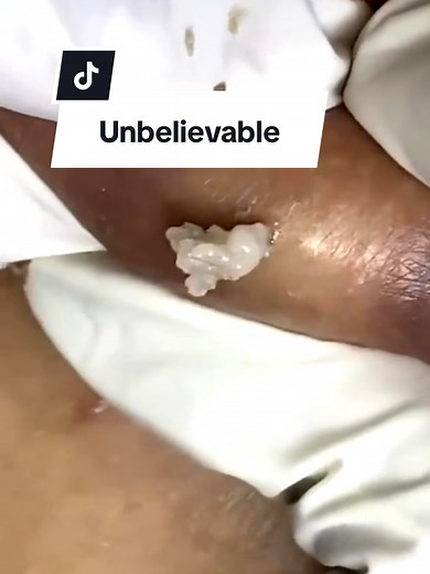 Blackheads Remover Satisfying Video: Unbelievable Blackhead Pops