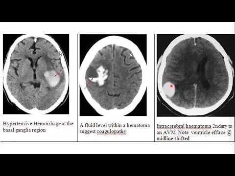 Basics of brain CT scan part III