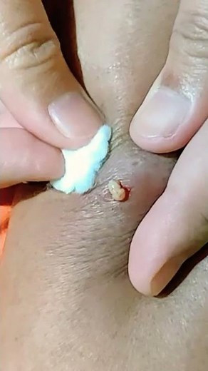 How to Get the Core Out of a Boil #short #relaxing😂 #most satisfying video #satisfying