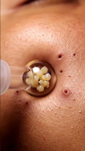 Dermatology Level Extraction — Pure Clean