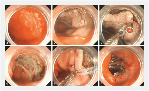 Application of “8”-loop traction-assisted duodenal endoscopic submucosal dissection and defect closure