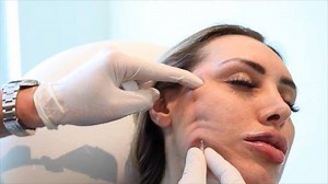 Our patients are LIVING for our PDO thread treatments! Our technique is unlike any other and the results are unparalleled 💯🙌🏼 We do BROW LIFTS✨NECK LIFT✨MIDFACE LIFT✨UNDER-EYE SMOOTHING✨and MORE! ————————————————— WHAT ARE PDO THREADS? PDO threads are hypodermic needles preloaded with an absorbable PDO suture. PDO stands for polydioxanone. It's a synthetic absorbable surgical suture composed of polydioxanone. ————————————————— WHAT IS THE PDO THREAD LIFT? PDO thread lifts utilize thin threads