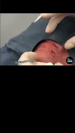 Dr Pimple Popper POPS Massive Chin Cyst!