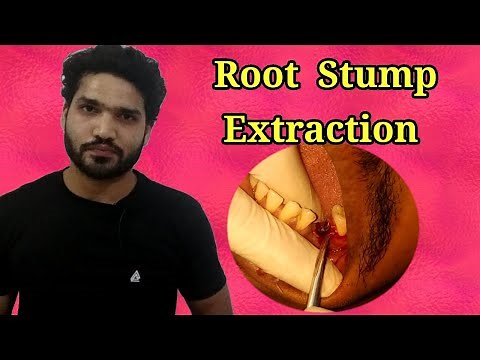 Extraction of Root stump | Root piece removal |Prmolar grossly decayed root extraction